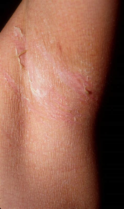 Staphylococcal Scalded Skin Syndrome متلازمة الجلد المسموط بالجراثيم