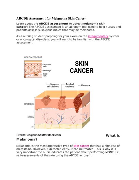 Abcde Assessment For Melanoma Skin Cancer Abcde Assessment For