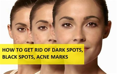 16 Best Homeremedies For Dark Spots And Black Spots Ultimate Guide