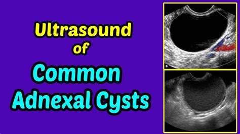 Ultrasound Of Common Adnexal Cysts Youtube