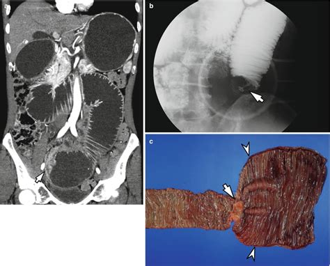 malignant tumors of the small bowel radiology key