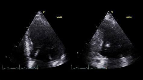 A prospective randomized controlled trial (rct) was conducted. 2-D Echocardiographic Morphology of End-Diastolic and End ...