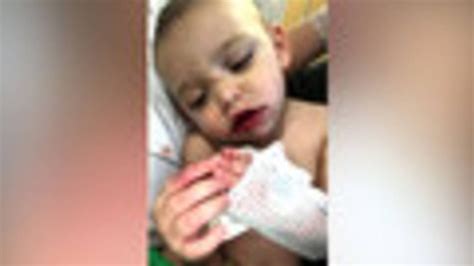 Baby Recovering After Outbreak Of Cold Sores Youtube