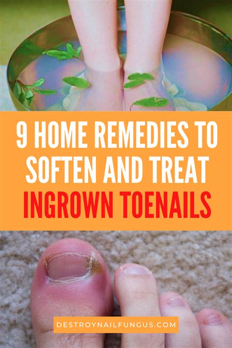 How To Soften Ingrown Toenails 9 Home Remedies That Work