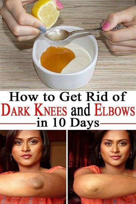 How To Get Rid Of Dark Elbows And Knees In 10 Days Health And Beauty