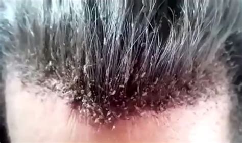Head Full Of Lice Is The Weirdest Video You Will Ever See