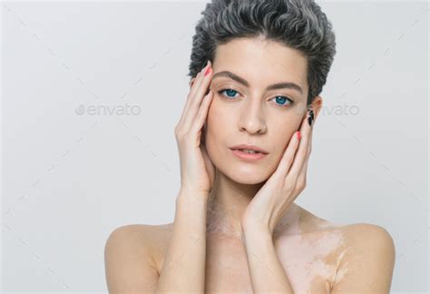 Vitiligo Pigment Woman Skin Unusual Beauty Portrait Woman Skin Beauty