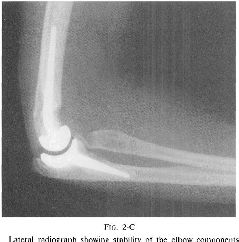 Results Of Total Elbow Arthroplasty After Excision Of The Radial Head