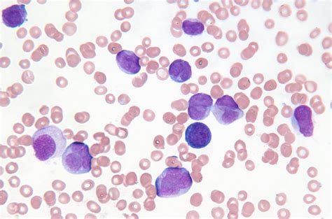 What Is The Difference Between Leukemia And Blood Cancer Cancerwalls
