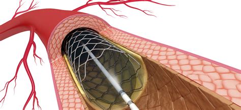 Percutaneous Coronary Intervention Conditions And Treatments Ut