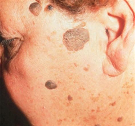 Seborrheic Keratosis Humble Dermatology Dermatologists