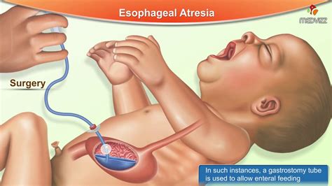 Esophageal Atresia Etiology Types Pathophysiology Clinical Hot