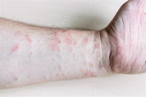 Ink Rash On Inner Side Of Forearm Close Up 11186198 Stock Photo At Vecteezy