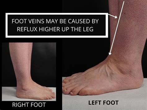 Varicose Veins In Feet The Veincare Centre