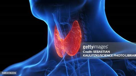 Hashimotos Thyroiditis Photos And Premium High Res Pictures Getty Images