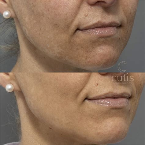 Melasma Picosure Pro Cutis Dermatology