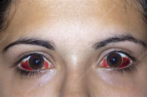 Bleeding In The Eyes Stock Image M Science Photo Library