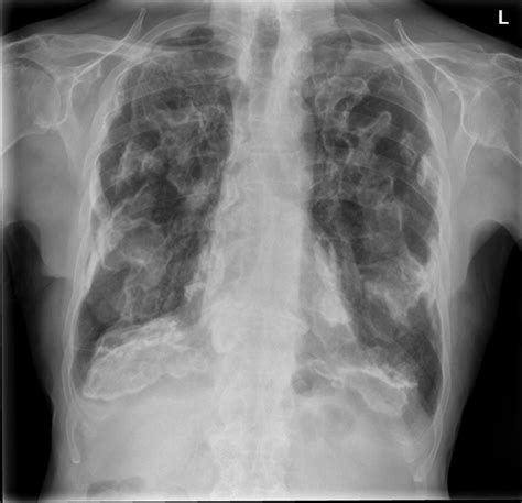 Calcified Pleural Plaques Radiology Case Radiopaedia Org