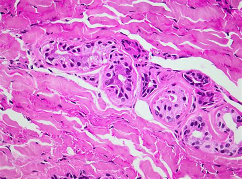 Eccrine Sweat Gland Coil Bound Down By The Abnormal Surrounding