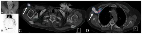 Cancers Free Full Text Oncologic Imaging Of The Lymphatic System