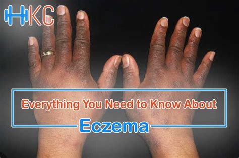 Everything You Need To Know About Eczema In 2020 Eczema Everything
