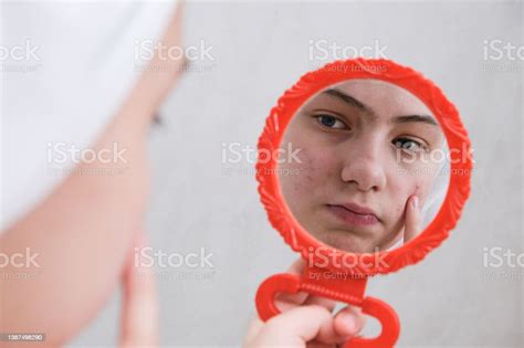 Sad Teenage Girl Problematic Skin In Adolescents Stock Photo Download