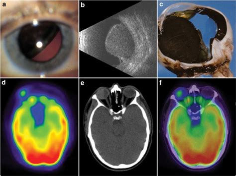 Visualization Of Primary Uveal Melanoma With Petct Scan Eye