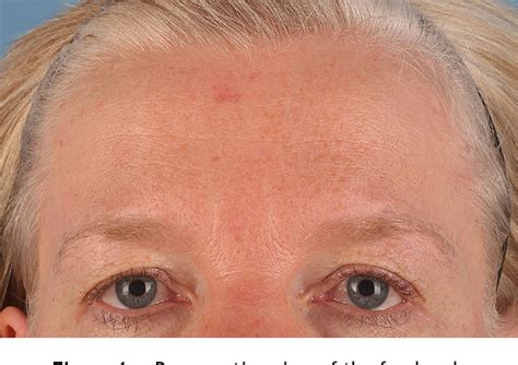 Figure 2 From Surgical Treatment Of A Basal Cell Carcinoma In The Upper