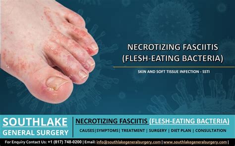 Necrotizing Fasciitis Flesh Eating Bacteria Ssti Southlake