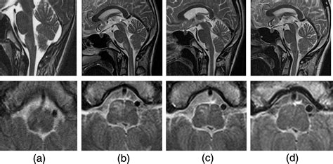 A Case Of Adem With Atypical Mri Findings Of A Centrally Located Long