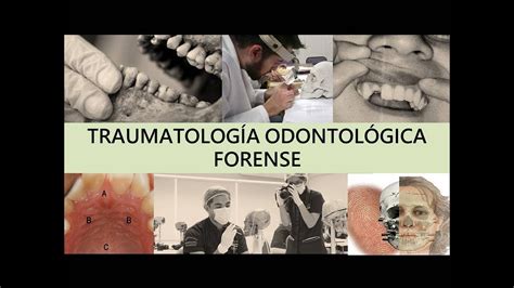 TraumatologÍa OdontolÓgica Forense Por El Dr Guillermo Montenegro