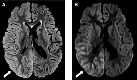 Axial Flair A Exhibits Cortical T2 Hyperintense Signal Throughout