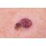 Signs Of Melanoma Pictures – 27 Photos & Images / Illnesseecom