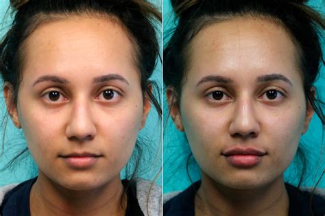 Lip Injections Before And After Photos The Naderi Center For Plastic