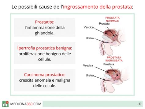 Dacryocystitis Magnetoter Pia Prostata Ingrossata Sintomi