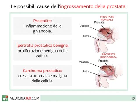 Ostello Schiudere Bloccare Tumore Prostata Stadio Avanzato Sintomi