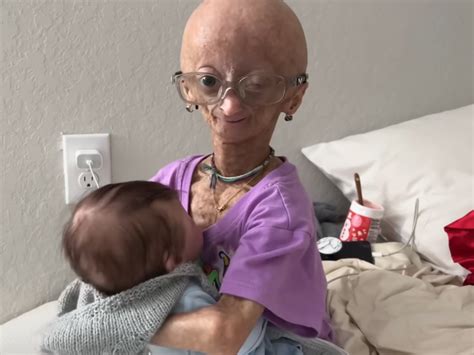 Adalia Rose Williams Youtuber With Progeria Has Died At 15