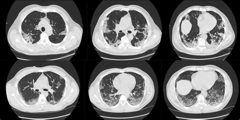 Examples Of Ct Scans Of Chest Pathologic Findings Predominant Ggos