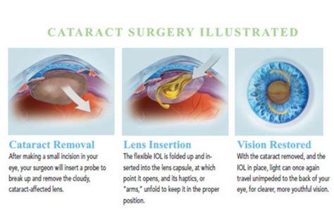 A New Post Cataract Surgery Antibioticsteroid Ducressa Cataract
