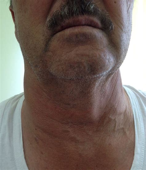 An Unusual Cause Of Sore Throat And Neck Swelling Emergency Medicine