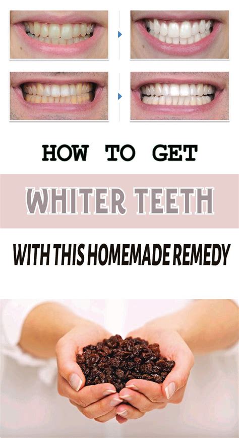 How To Get Whiter Teeth With This Homemade Remedy Get Whiter Teeth