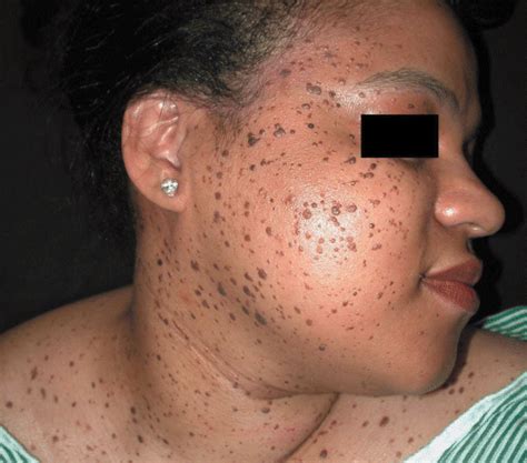 Eruptive Dermatosis Papulosa Nigra As A Possible Sign Of Internal