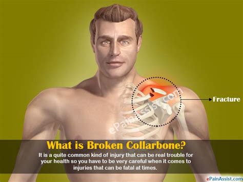 Ways To Deal With Broken Collarbone And How Long Does It Take To Heal A