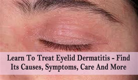Learn To Treat Eyelid Dermatitis Find Its Causes Symptoms Care And More
