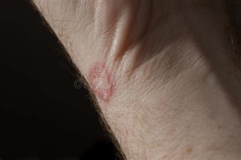 The Affected Skin Armpit Underarm Rash Infections Ringworm Bacterial