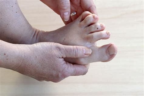 Stiff Big Toe Joint Pain Number Three Consulting Footpain