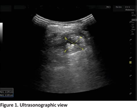 Figure 1 From The Role Of Ultrasonography To Estimate Gastric Content