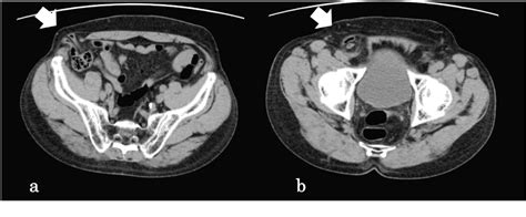 Figure 1 From Laparoscopic Totally Extra Peritoneal Hernia Repair For