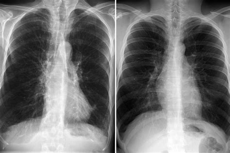Copd Lungs Vs Normal Lungs On Medical Scans