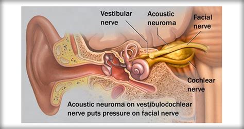 Acoustic Neuroma Nursing Management And Interventions Nurseslabs